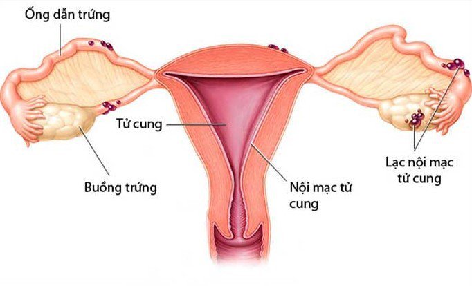 Lạc nội mạc tử cung có thể dẫn đến kinh nguyệt ra máu đông nhìn như bào thai