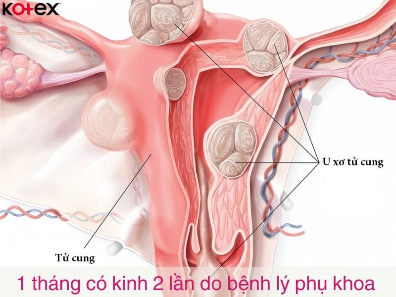 1 tháng có kinh 2 lần