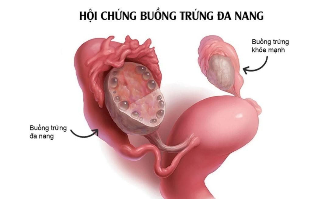 3 tháng không có kinh nguyệt