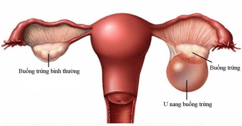buồng trứng đa nang có rụng trứng không