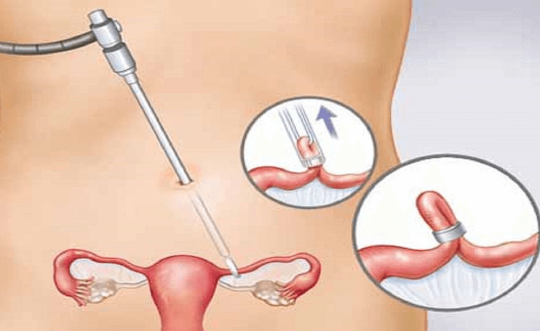 các biện pháp tránh thai