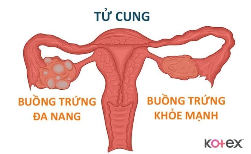 cách trị kinh nguyệt ra ít tại nhà kinh nguyệt ra ít nên uống thuốc gì