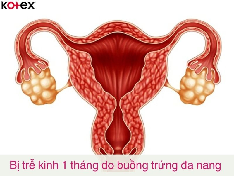 chậm kinh 1 tháng