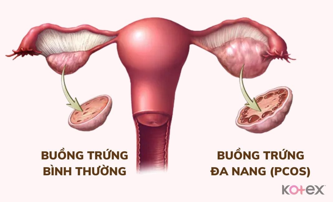 chậm kinh ra khí hư màu trắng sữa