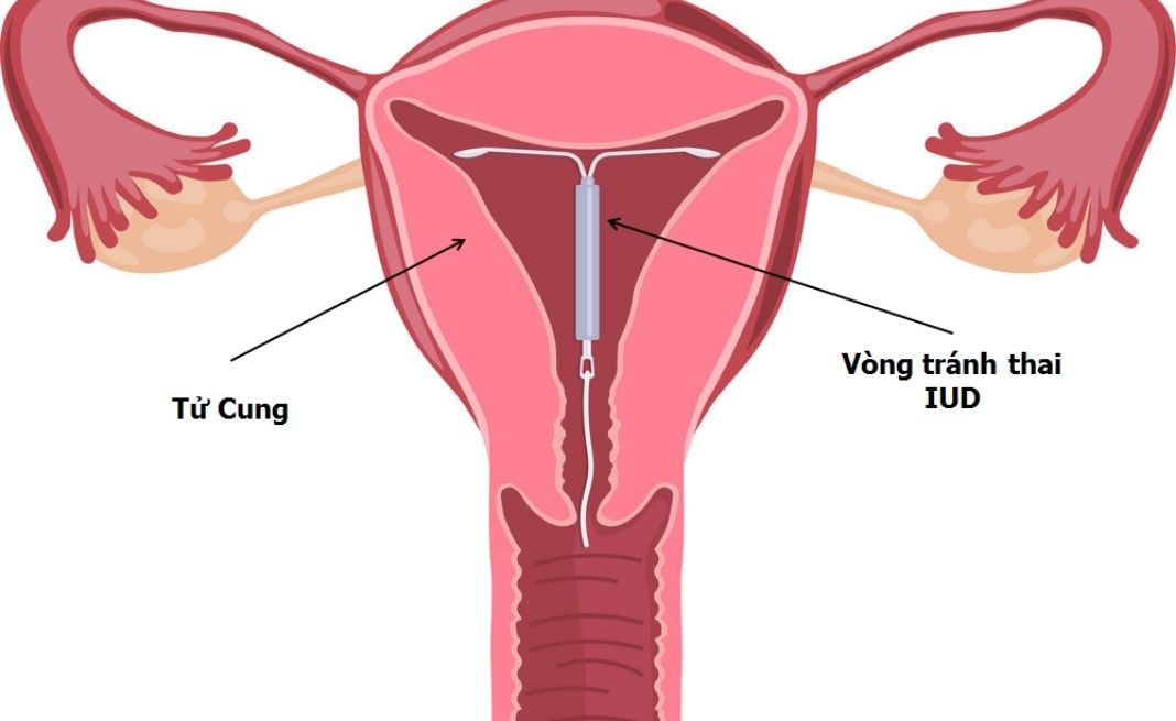 đặt vòng tránh thai có đau không