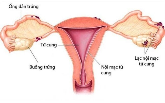 đau bụng kinh dữ dội buồn nôn