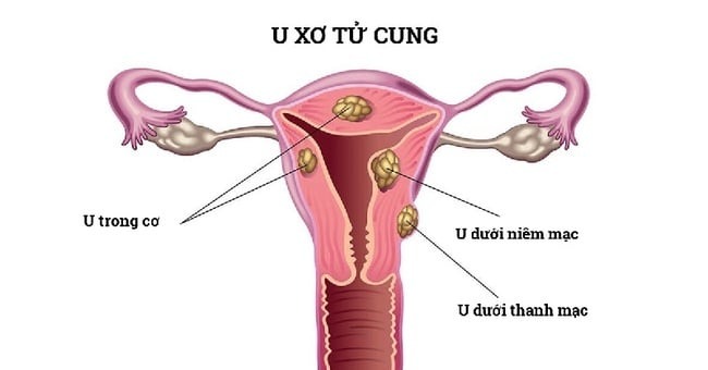 đau bụng kinh dữ dội buồn nôn
