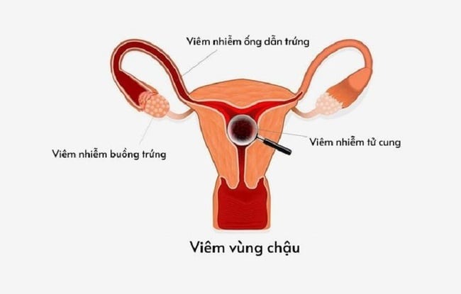 đau bụng kinh dữ dội buồn nôn