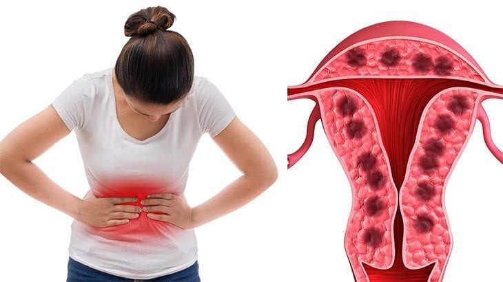 đau bụng kinh là gì