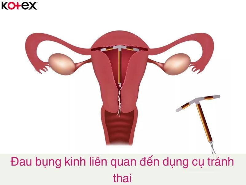 đau bụng kinh là gì
