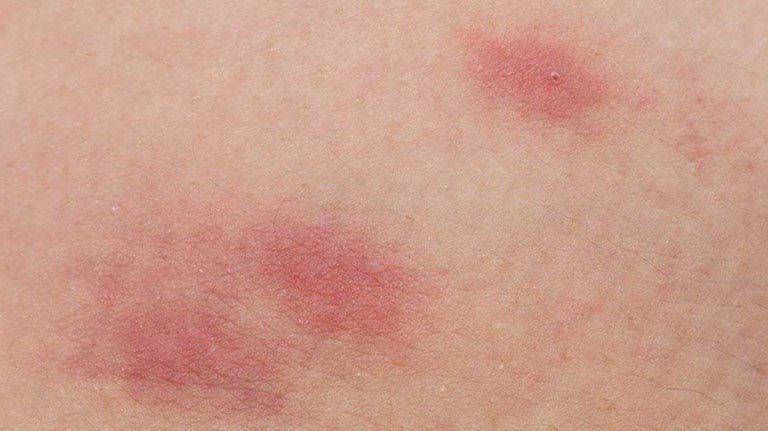 đóng băng vệ sinh bị hăm