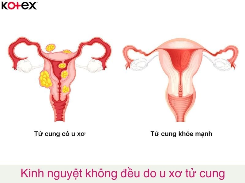 kinh nguyệt không đều