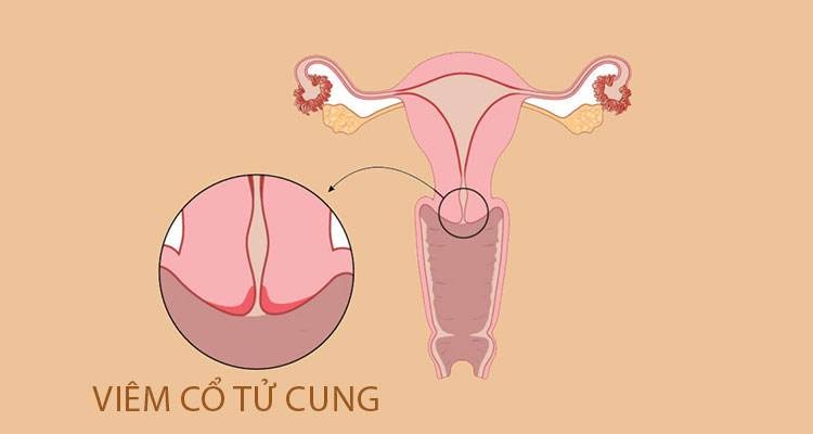 khí hư có mùi chua