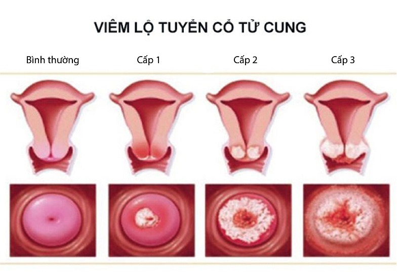 khí hư đặc