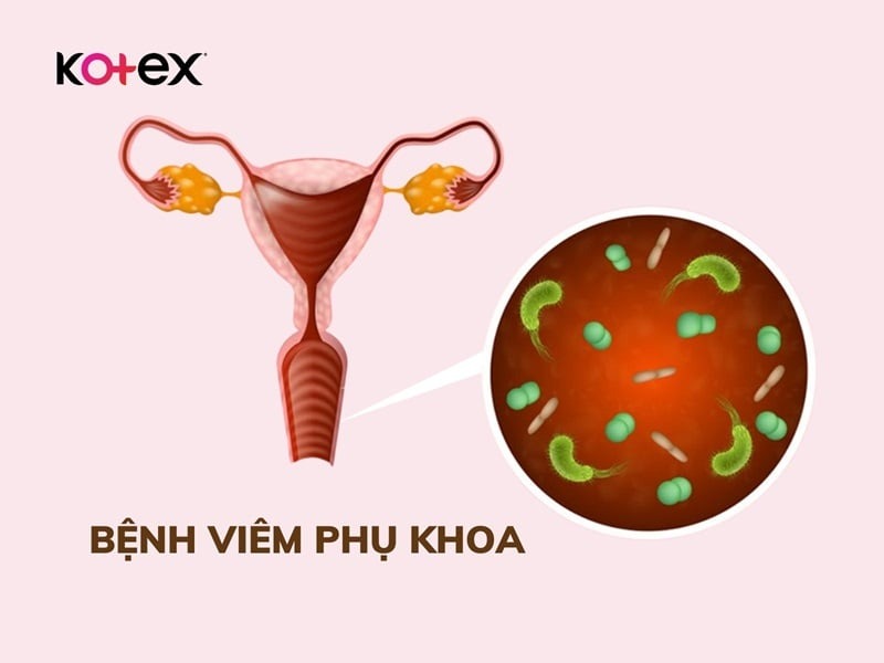 khí hư màu nâu