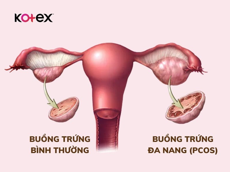 khí hư màu nâu