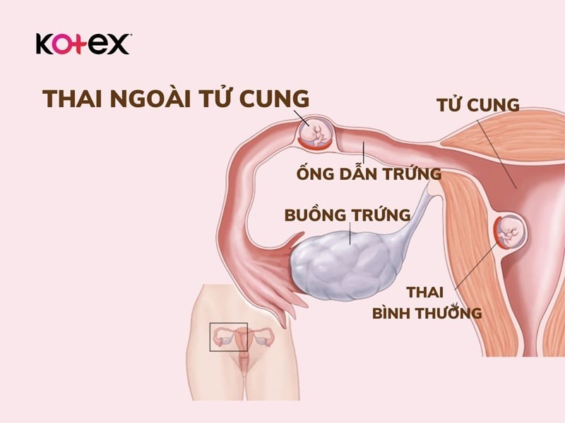 khí hư màu nâu