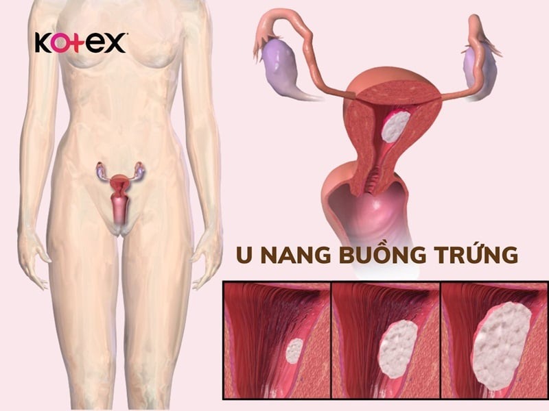 khí hư màu nâu