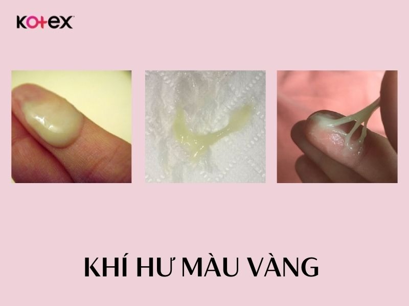 khí hư màu vàng