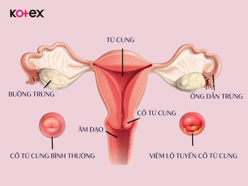 khí hư màu vàng