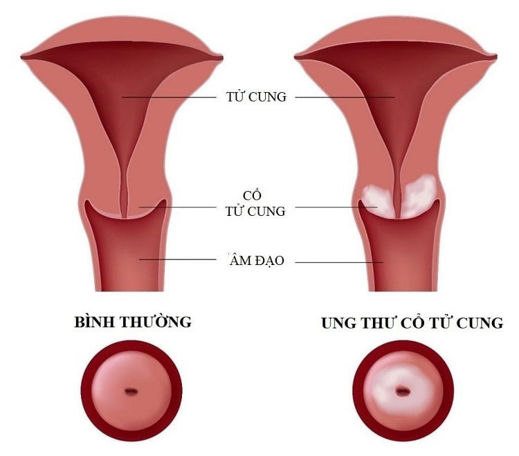 máu kinh nguyệt nhớt