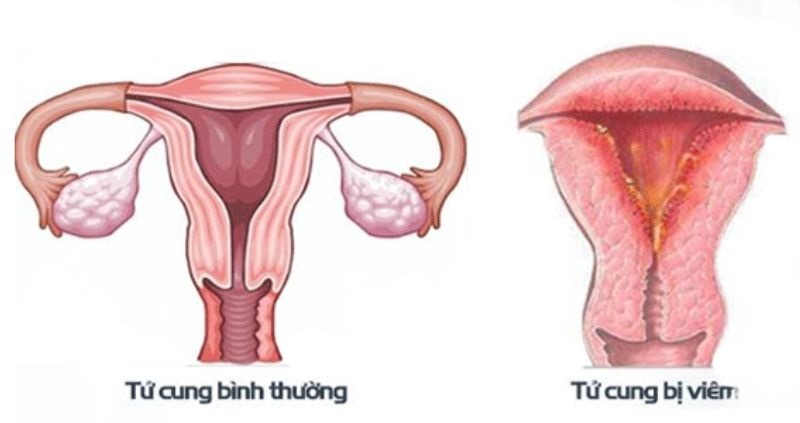 máu kinh nguyệt nhớt
