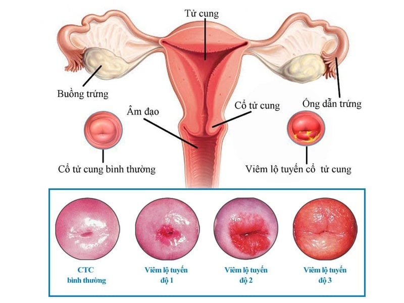 máu kinh nguyệt nhớt