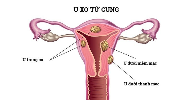 tháng nào cũng trễ kinh