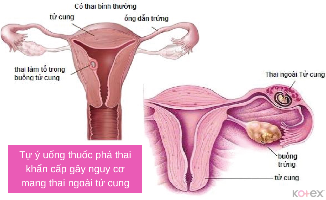 thuốc phá thai khẩn cấp