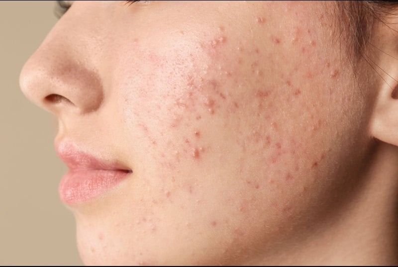 tới tháng có nên nận mụn không