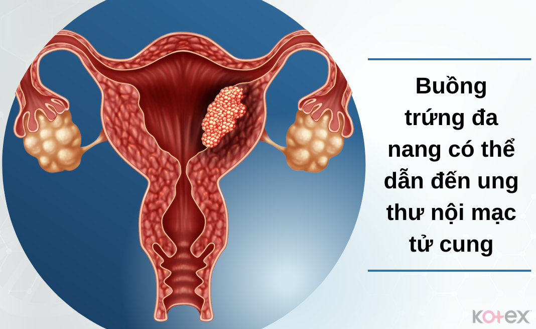 Bệnh buồng trứng đa nang làm tăng nguy cơ bị ung thư nội mạc tử cung