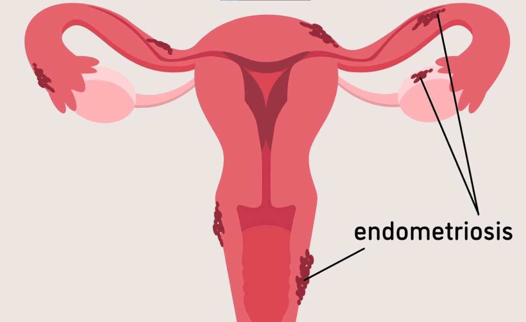 Hình ảnh các tế bào nội mạc tử cung nằm rải rác bên ngoài tử cung
