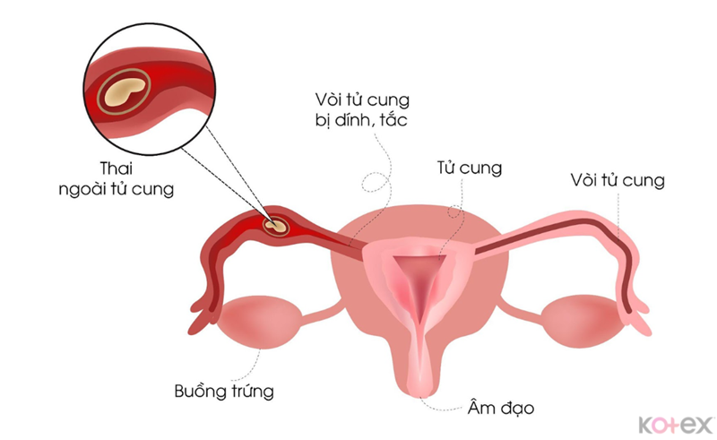Ra máu khi có thai ngoài tử cung dễ bị nhầm thành kinh nguyệt ra ít