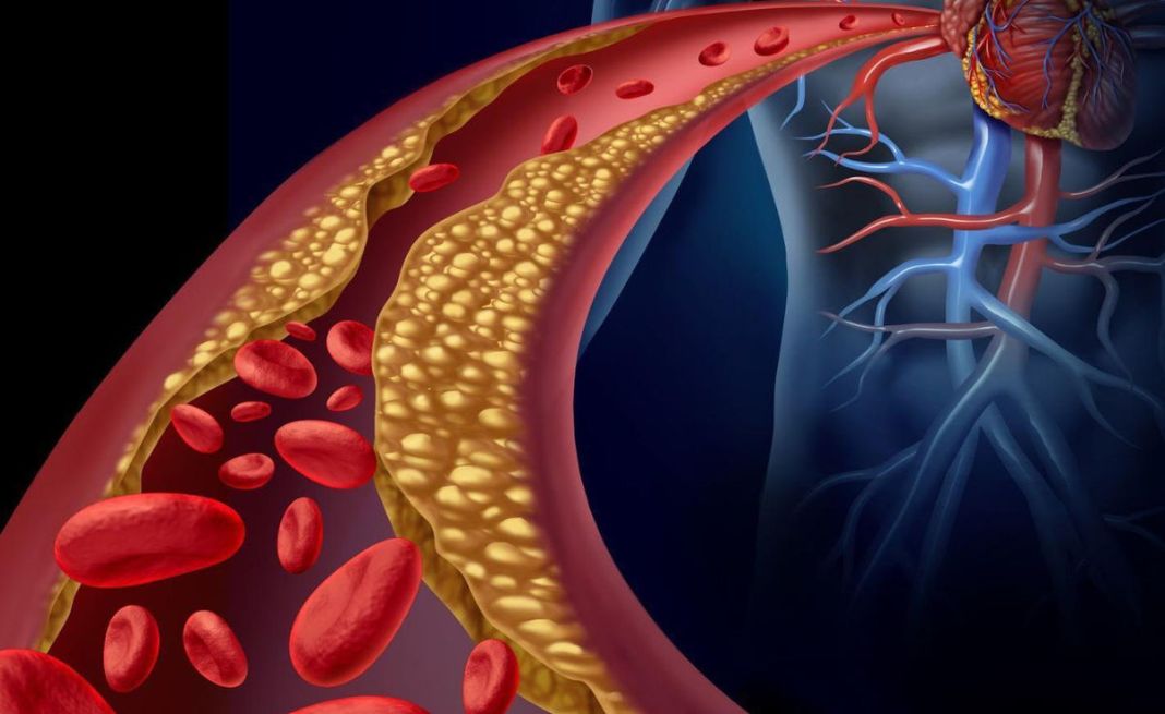 Thay đổi mức Cholesterol khi sắp hết kinh góp phần gia tăng nguy cơ mắc bệnh tim