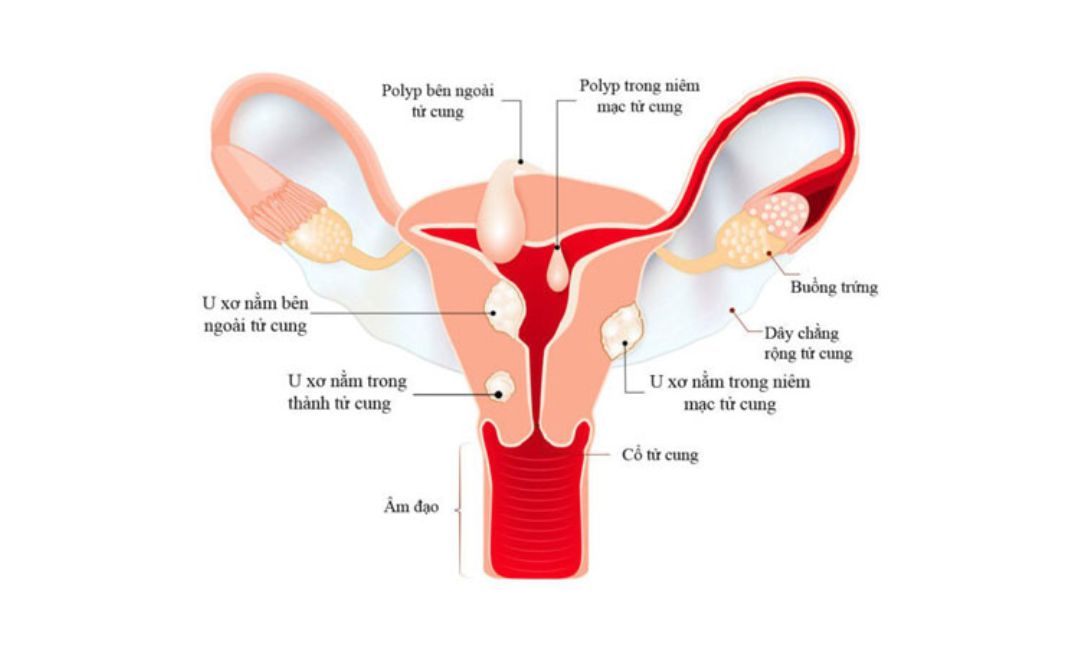 Các bệnh lý phụ khoa liên quan đến tử cung, buồng trứng dễ dàng dẫn đến rối loạn kinh nguyệt ở nữ giới