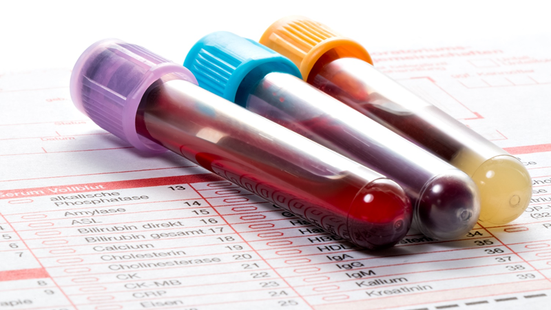 Xét nghiệm máu là biện pháp chẩn đoán Hội chứng sốc nhiễm độc