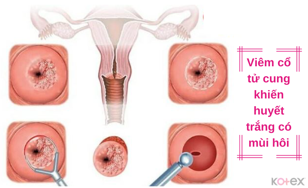 Bệnh viêm cổ tử cung khiến dịch âm tạo có mùi hôi khó chịu