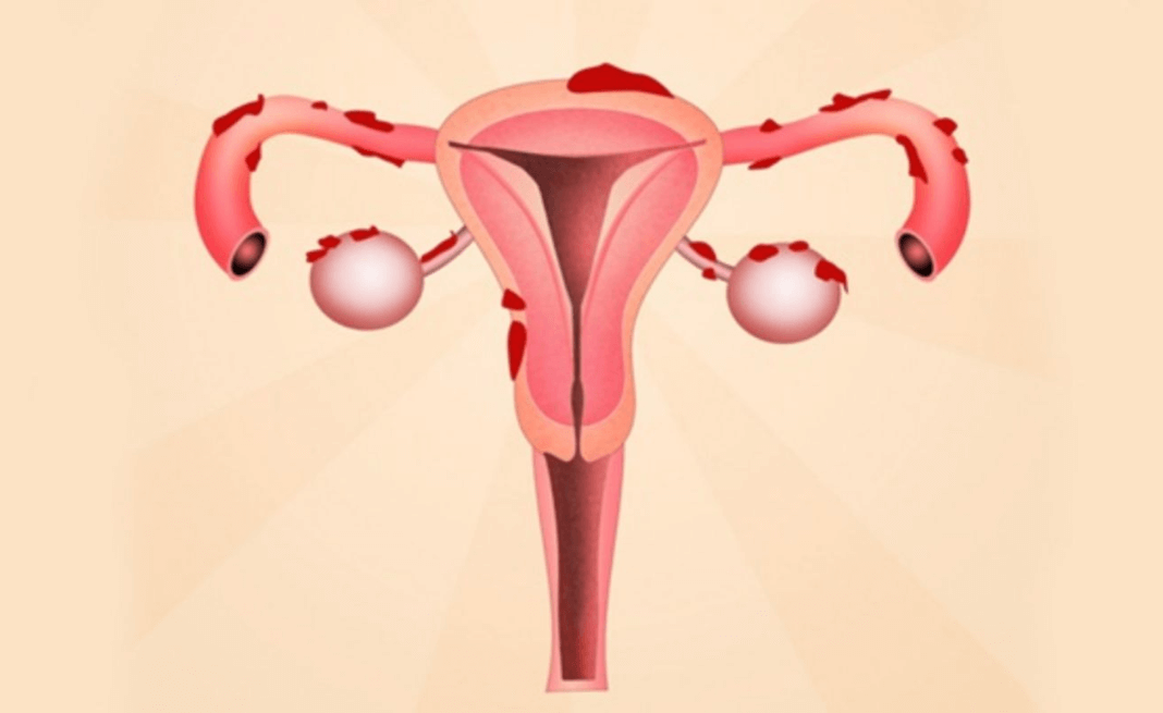 Lạc nội mạc tử cung có thể ảnh hưởng đến khả năng sinh sản của bạn nữ