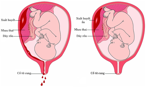 Nhau bong non thường gặp ở thai phụ cao huyết áp