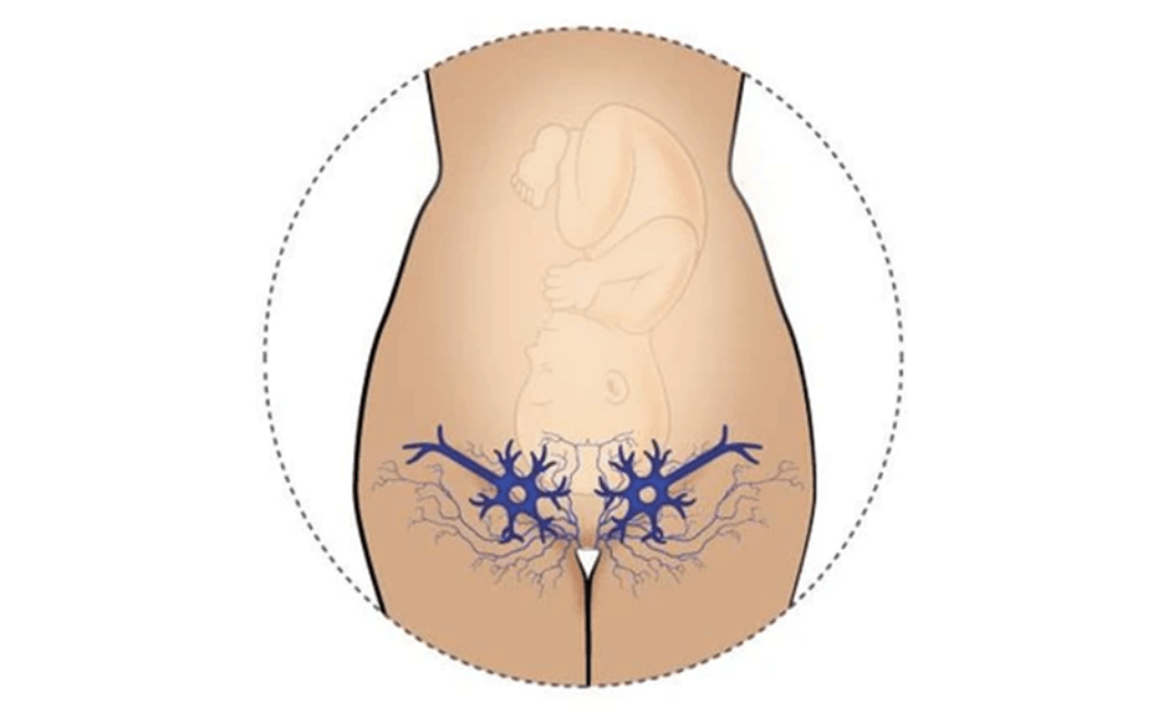 Giãn tĩnh mạch xung quanh âm hộ thường xảy ra ở phụ nữ mang thai 
