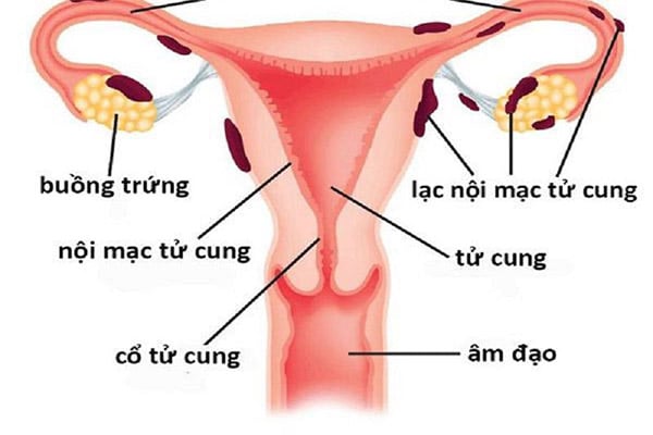 Bệnh lý lạc nội mạc tử cung