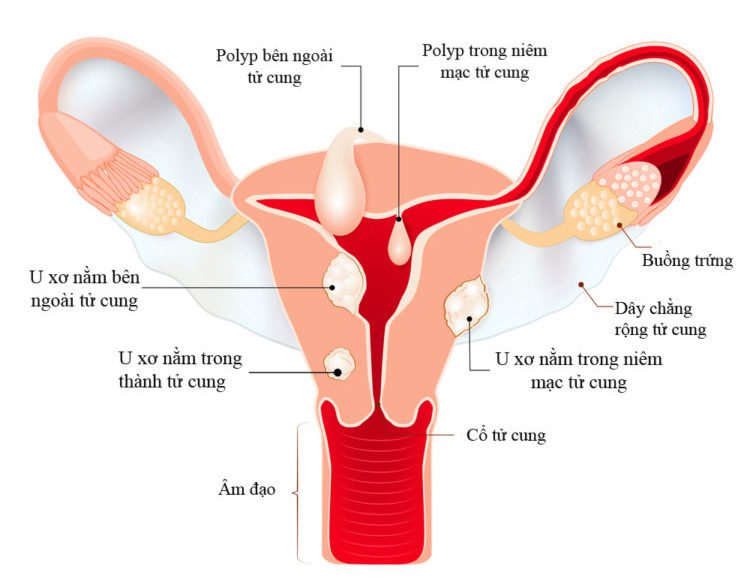 U xơ cổ tử cung gây đau bụng dưới