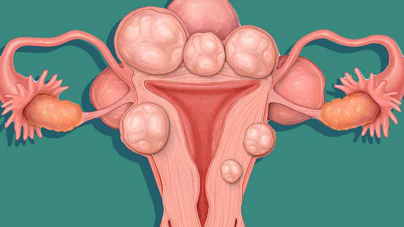 Một số bệnh lý như u nang buồng trứng và u xơ tử cung là nguyên nhân tới tháng nhưng không có kinh
